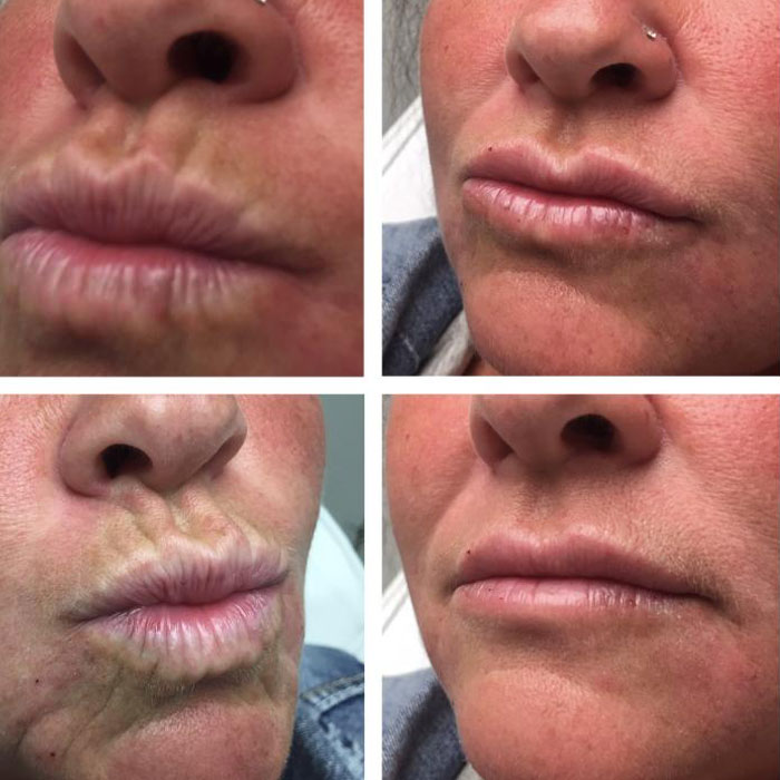 Woodbine Cosmetic Clinic Botox Injection