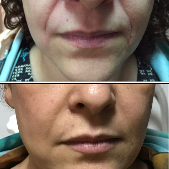 Woodbine Cosmetics Clinic Botox® Injections