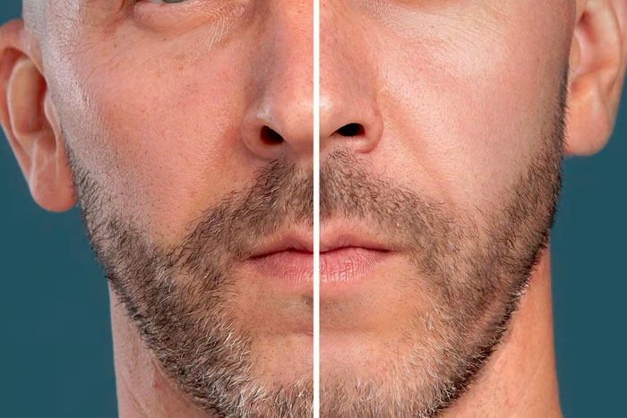 Double Chin Removal Treatment