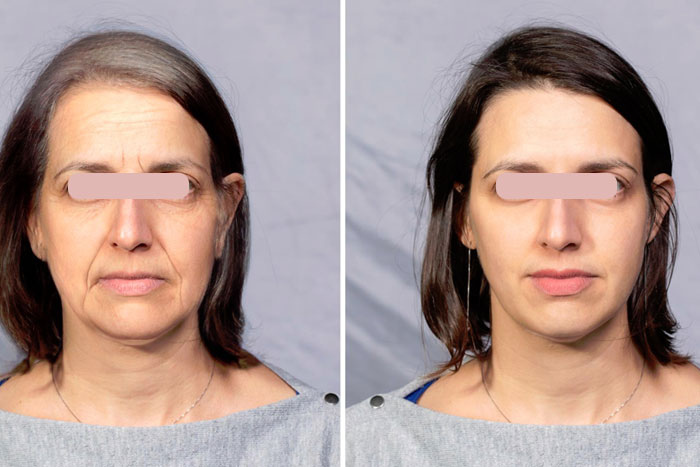 Double Chin Removal Treatment 