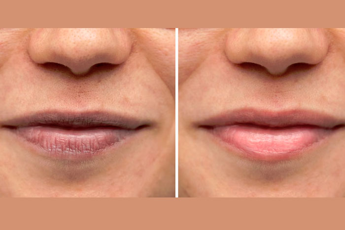 Lip Fillers & Injections Toronto