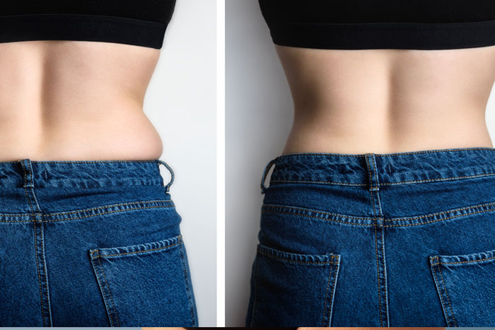 Body Fat Reduction With Lipolysis Injections